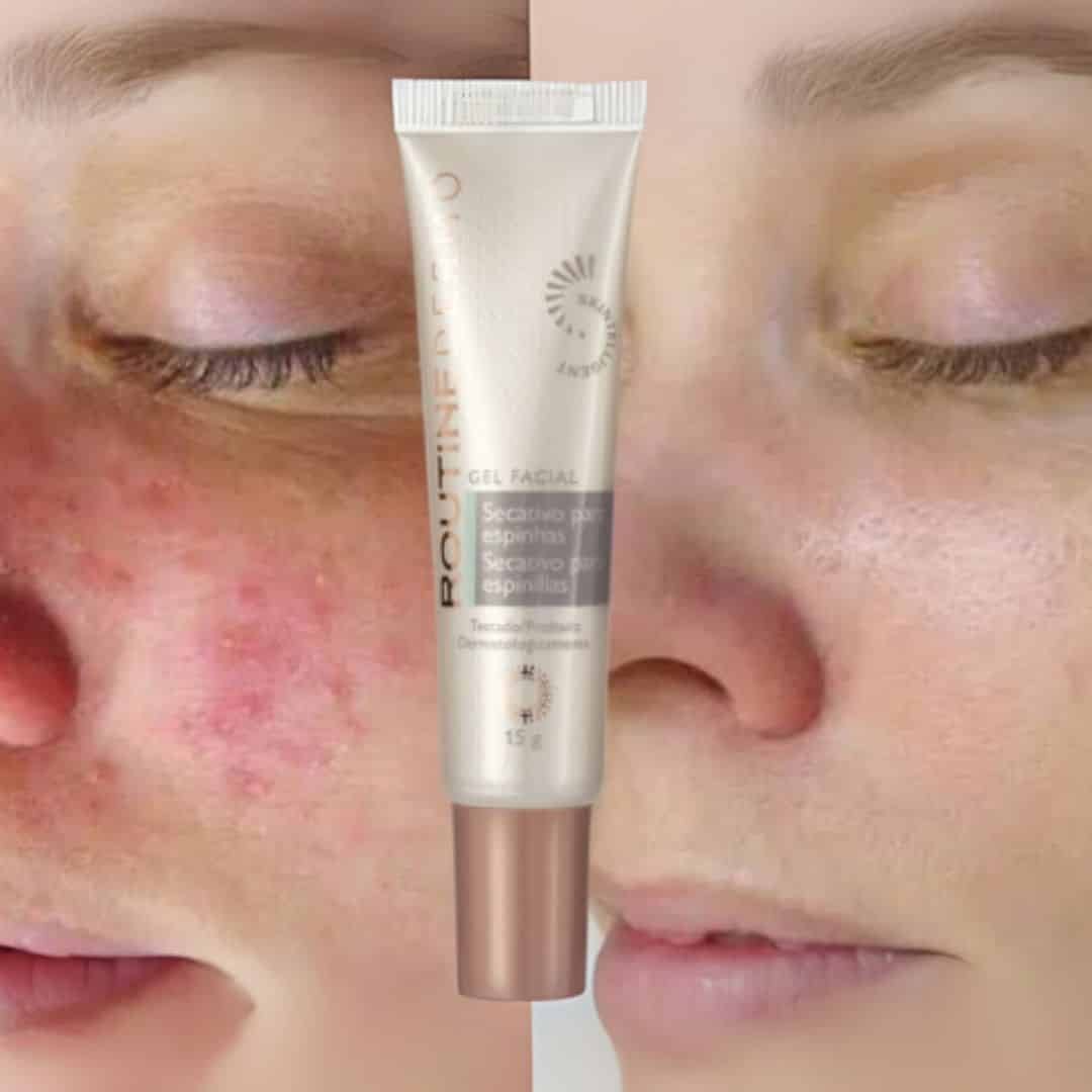 Gel Secativo de Acné – Hinode - Imagen 4